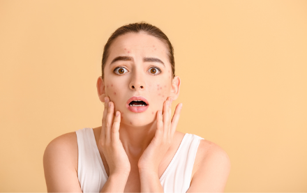 Picture of Akne in mozolji spet ob nepravem času?