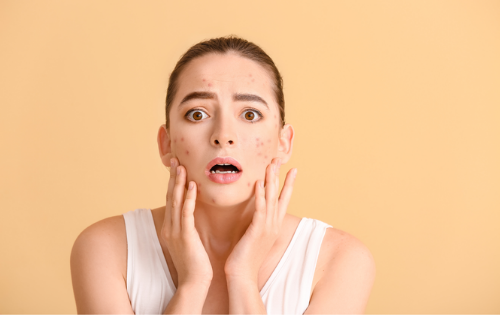 Akne in mozolji spet ob nepravem času?